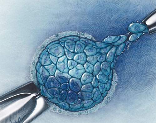 Diagnóstico Genético Preimplantacional