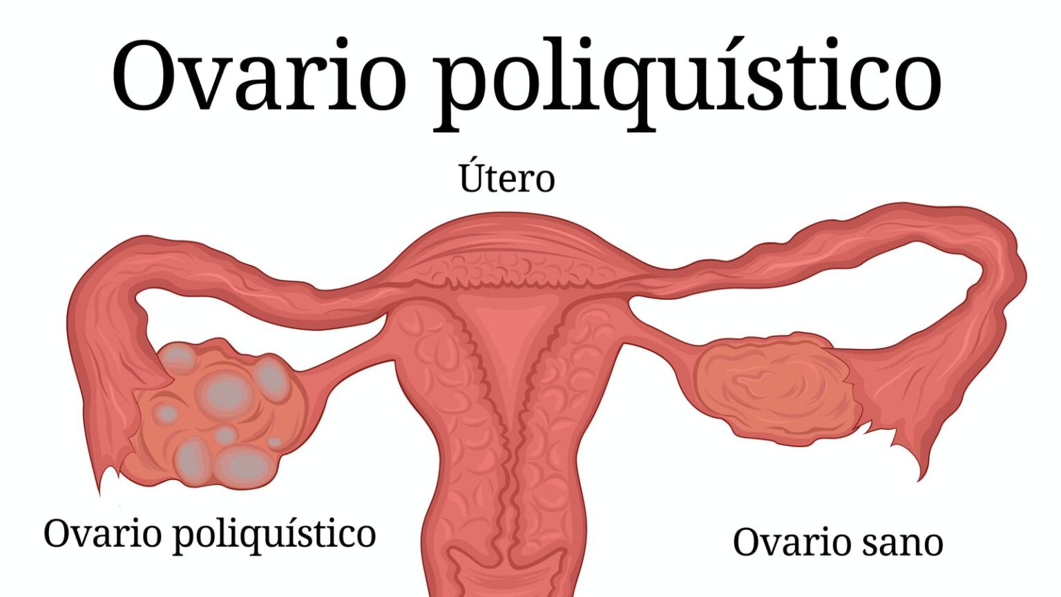 Síndrome Ovario Poliquístico Y Fertilidad Todo Lo Que Hay Que Saber In Vitro Buenos Aires 8612