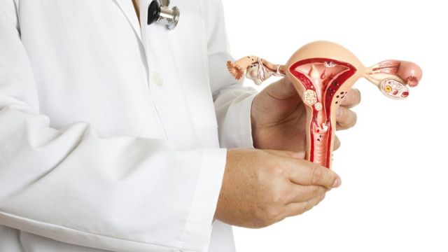 mioma uterino y la fertilidad