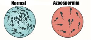 Azoospermia