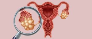 Síndrome de hiperestimulación ovárica - In Vitro Buenos Aires