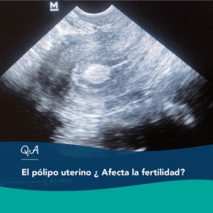 Pólipos Uterinos - In Vitro Buenos Aires